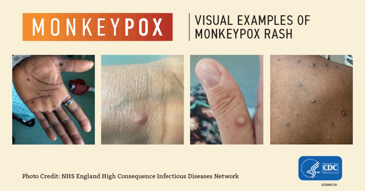 Monkeypox